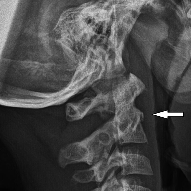 Lateral cervical radiograph showing long-term spinal alignment and hardware position