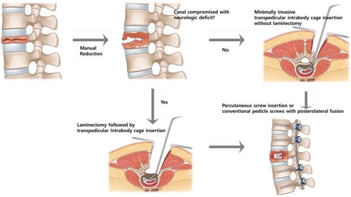 Schematic flow of surgical decision-making for laminectomy and transpedicular cage insertion