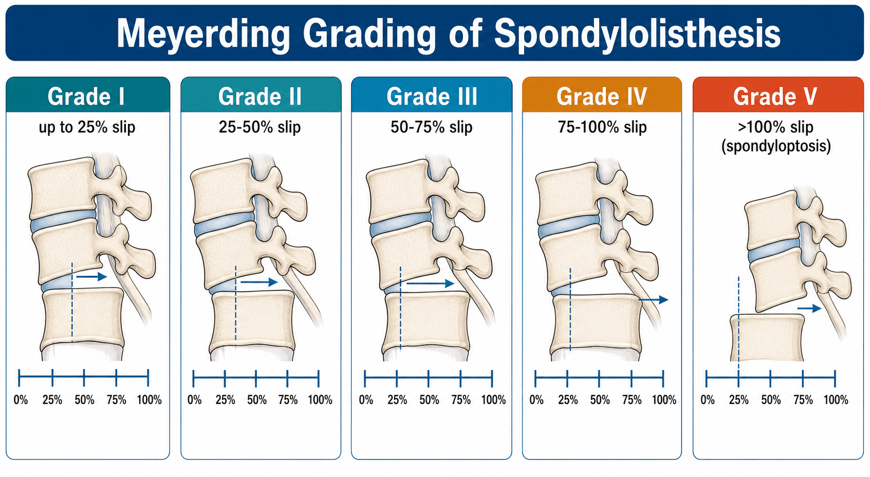 Meyerding grading of spondylolisthesis