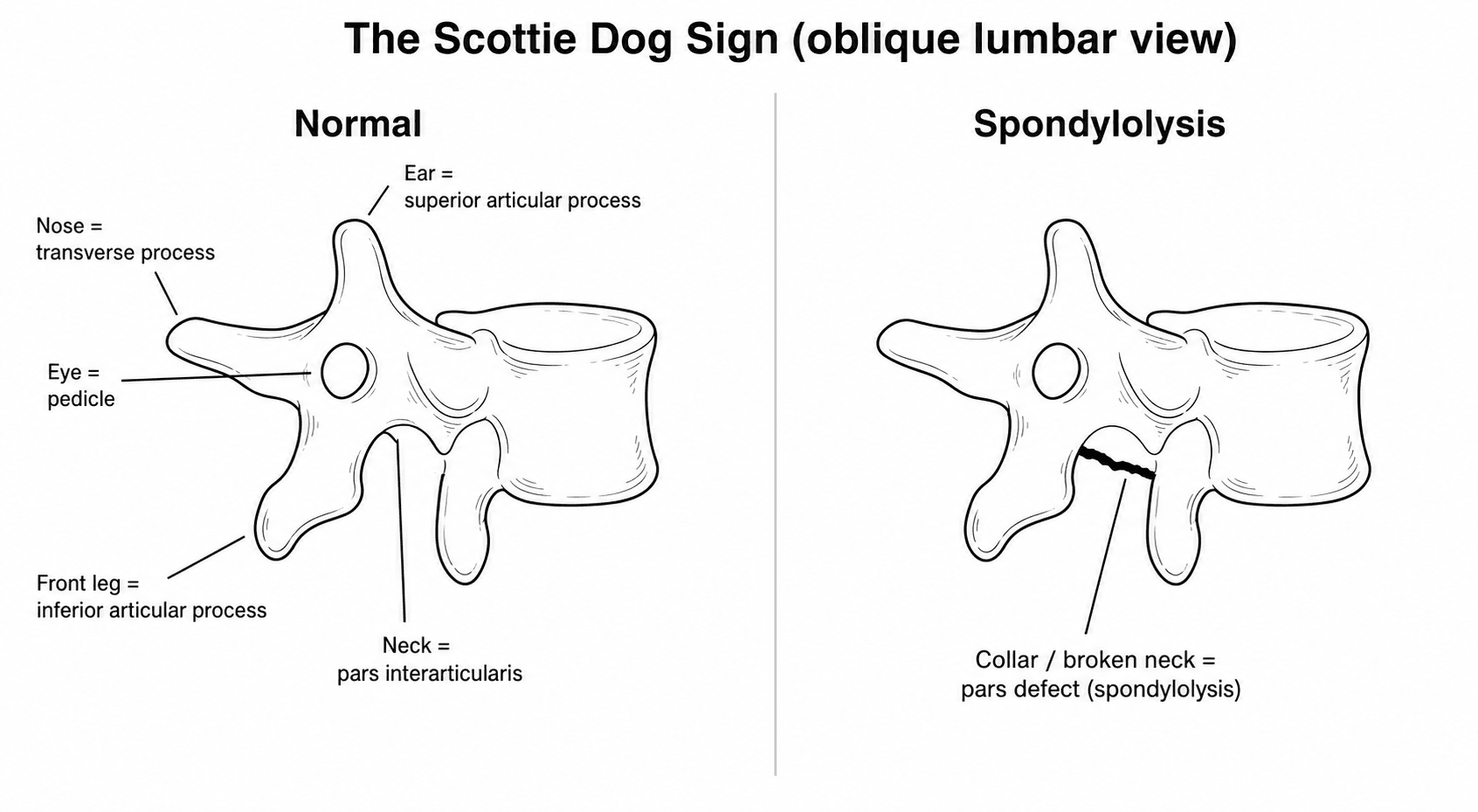 Diagram of the Scottie dog sign on an oblique lumbar radiograph, normal versus a pars defect breaking the dog's neck.