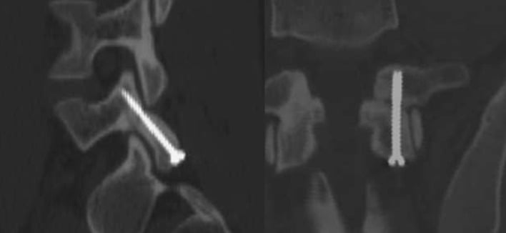 Axial and sagittal postoperative CT images showing minimally invasive screw fixation across bilateral L5 pars defects.