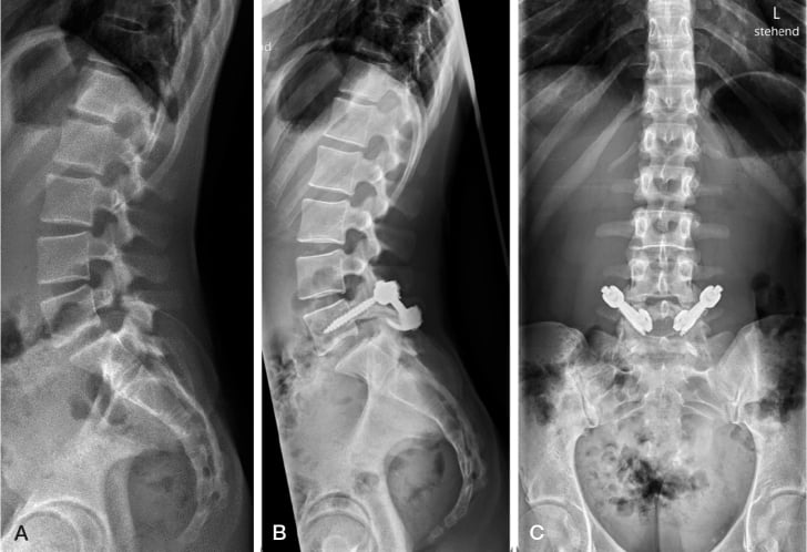 Operative drawings and postoperative radiographs of bilateral L5 pars pseudoarthrosis revision with pedicle screw and hook fixation.