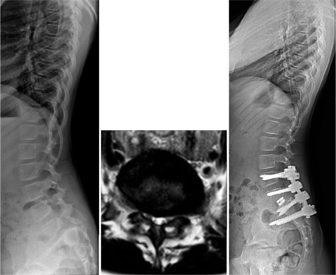 Standing lateral radiograph and axial T2 MRI of high-grade L5-S1 spondylolisthesis in a child.