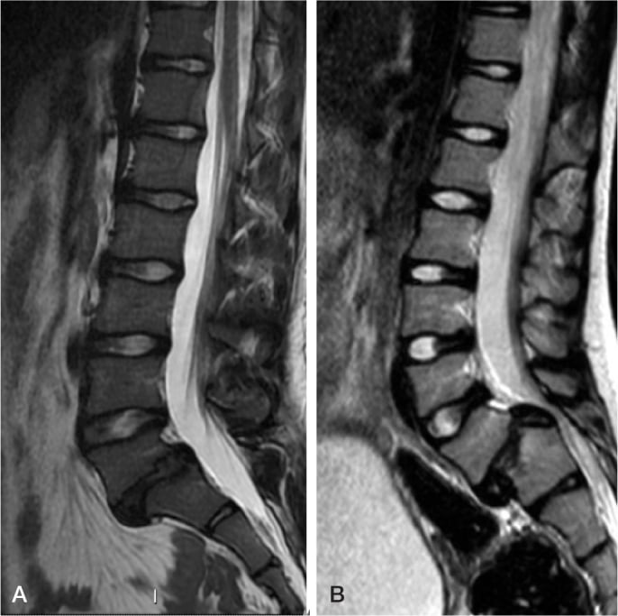 Paired sagittal T2 MRI images comparing isthmic and dysplastic L5-S1 spondylolisthesis.