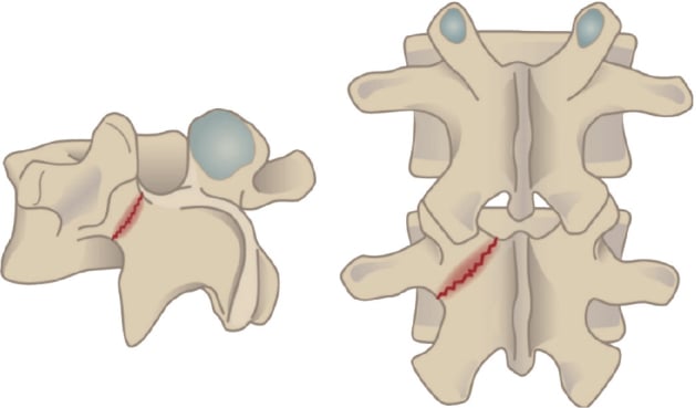 Anatomical drawing of a lumbar vertebra highlighting a stress fracture through the pars interarticularis.