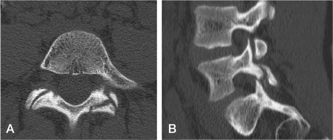 Axial and sagittal CT images showing progressive unilateral L5 pars interarticularis spondylolysis.