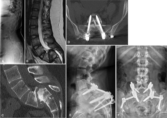 Standing radiograph, sagittal MRI, sagittal CT and postoperative radiograph of paediatric L5 spondyloptosis.