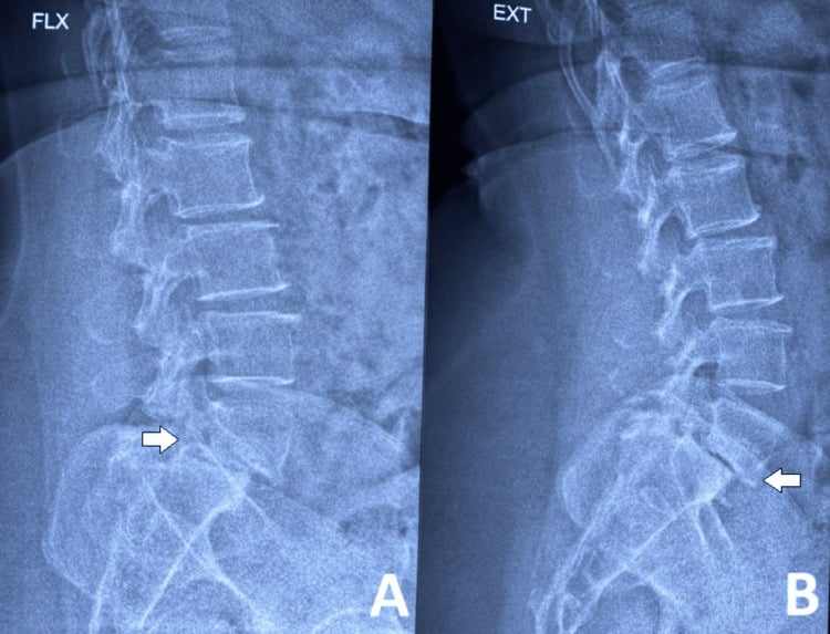 Lateral lumbar flexion and extension radiographs demonstrating dynamic L5-S1 spondylolisthesis.