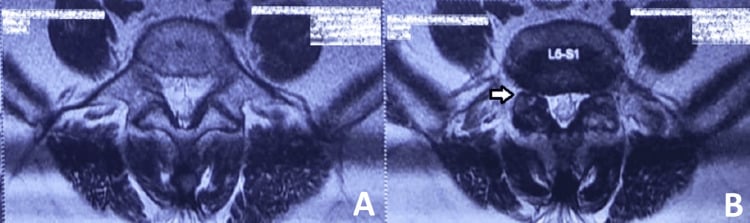 Axial T2 MRI at the L5-S1 disc level showing foraminal stenosis associated with spondylolisthesis.