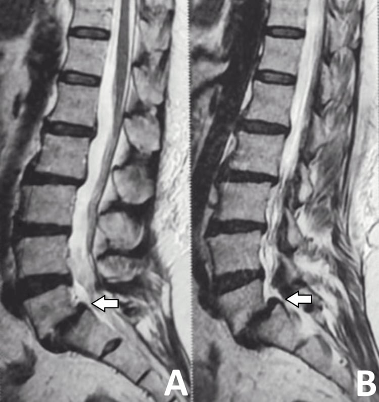 Paired sagittal T2 MRI images showing L5-S1 spondylolisthesis and a posterior pseudo-disc bulge.