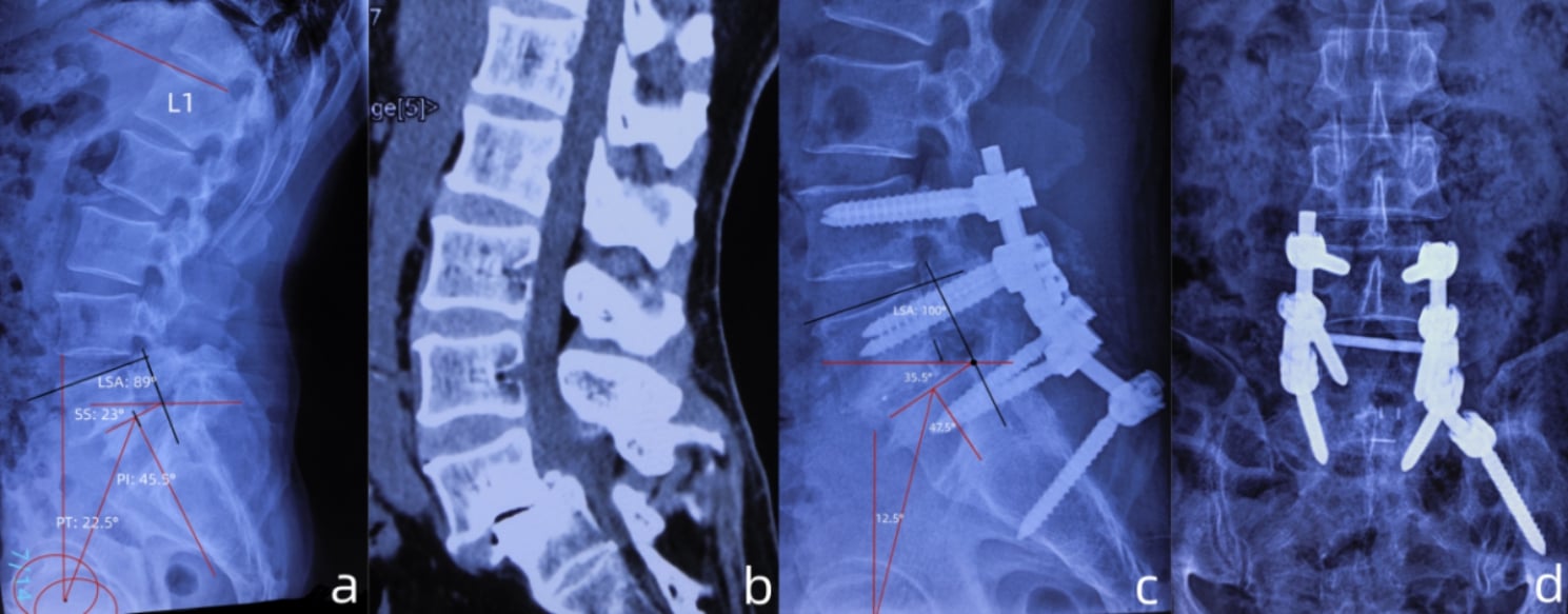Serial radiographs of a patient with grade III L5-S1 spondylolisthesis before, during and after instrumented partial reduction and fusion.