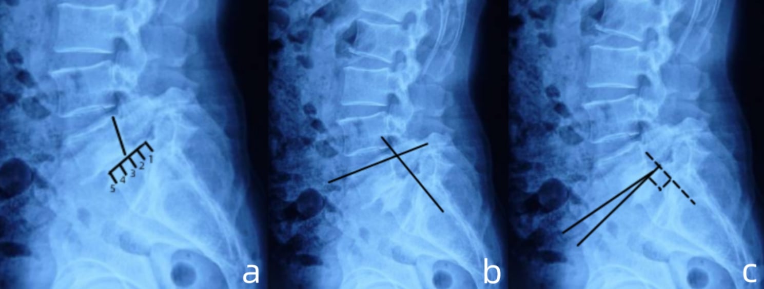 Standing lateral radiographs demonstrating measurement of slip distance, slip percentage and slip angle in high-grade L5-S1 spondylolisthesis.