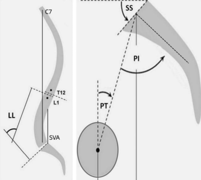 Standing lateral radiographs illustrating pelvic incidence, pelvic tilt and sacral slope measurements before and after high-grade spondylolisthesis correction.