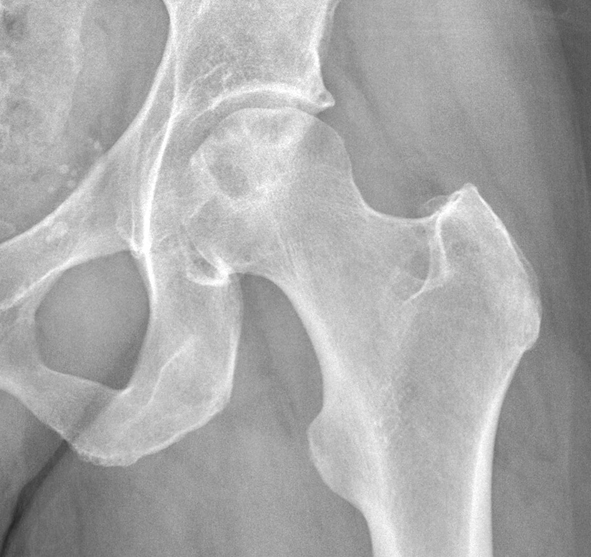 AP hip radiograph of avascular necrosis of the femoral head showing mottled sclerosis and lucency with a still-spherical head.