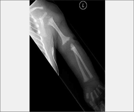 Radiograph of an upper limb in rhizomelic chondrodysplasia punctata showing a shortened humerus.