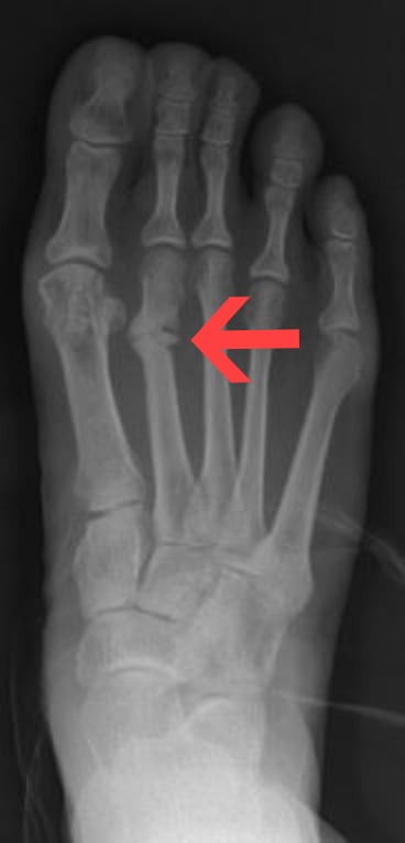 Foot radiograph of a healing second metatarsal stress fracture with callus.