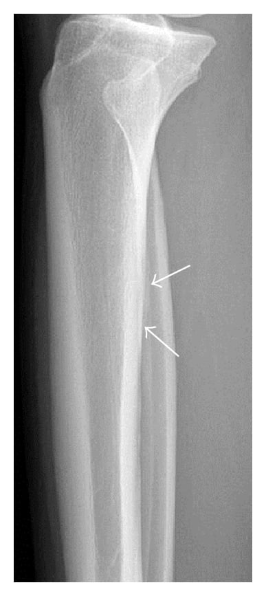 Radiograph of a tibial stress fracture showing subtle periosteal reaction.