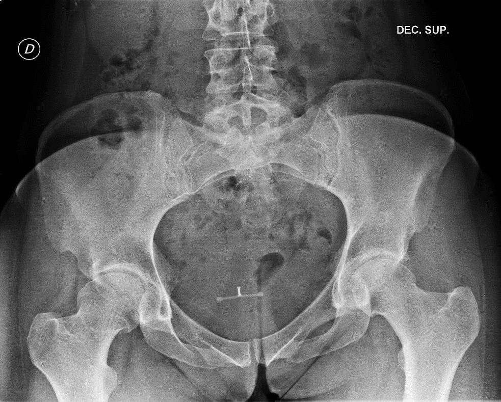 AP pelvis showing coxa plana of the right hip, a flattened enlarged femoral head, the healed deformity of Perthes disease.