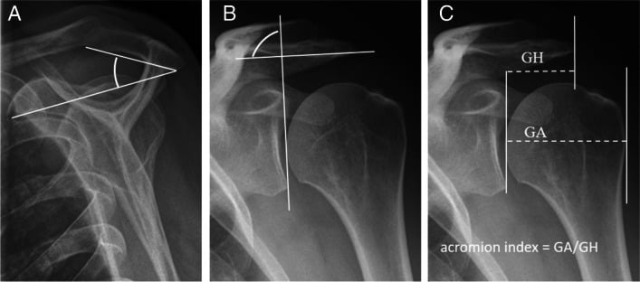 True anteroposterior shoulder radiographs showing acromial slope, critical shoulder angle and acromion index measurements.