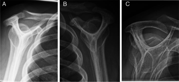 Outlet radiographs showing Bigliani Type I flat, Type II curved and Type III hooked acromial morphology.