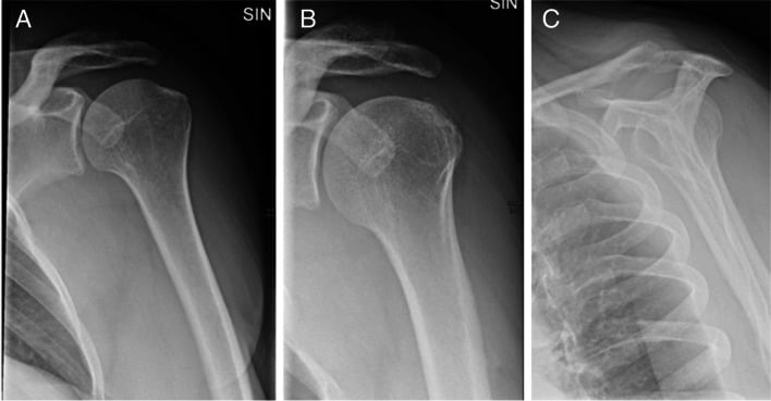 Shoulder radiographs in anteroposterior external rotation, anteroposterior internal rotation and outlet projections.