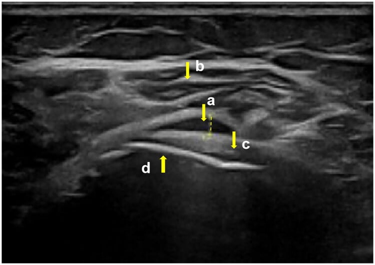 Ultrasound showing a thickened fluid-distended subacromial-subdeltoid bursa between the deltoid and humeral head.
