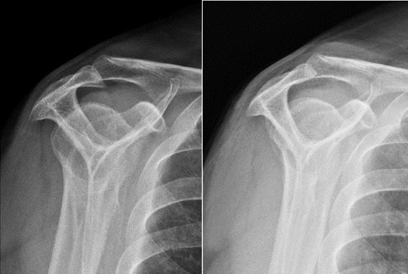 Supraspinatus outlet-view radiographs of a type III acromion before and after subacromial decompression.