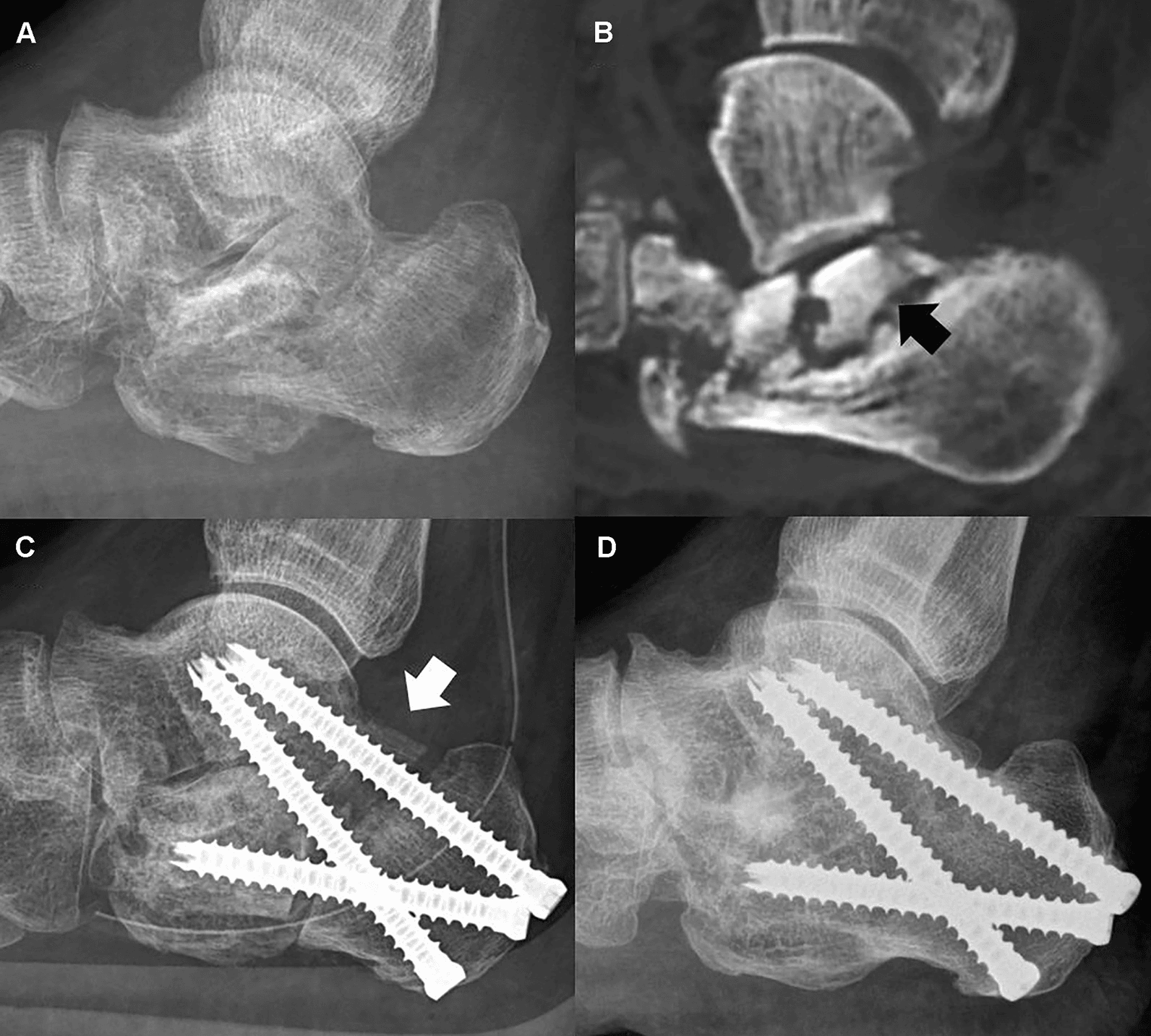 Lateral radiograph and CT of an avascular posterior facet, then radiographs after tricortical iliac graft fixed with three fully threaded screws