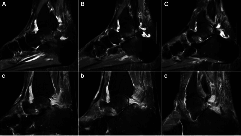 Six MRI panels, top row labelled A to C and bottom row c, b, c, showing marrow oedema around a symptomatic bipartite talus
