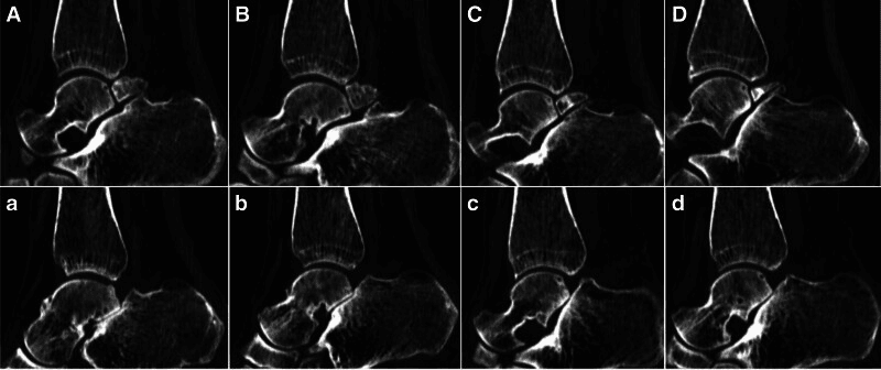 CT showing bipartite talus and subtalar degenerative changes