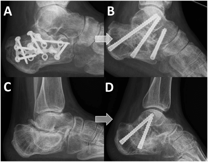 Lateral radiographs of two cases before (A, C) and after (B, D) subtalar arthrodesis, the first with earlier calcaneal plate fixation