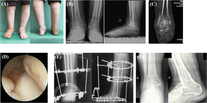 Radiograph CT and arthroscopy showing infected ankle and subtalar joint destruction