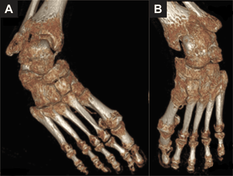 Two 3D CT reconstructions, A and B, of a severely deformed foot with degeneration across multiple joints