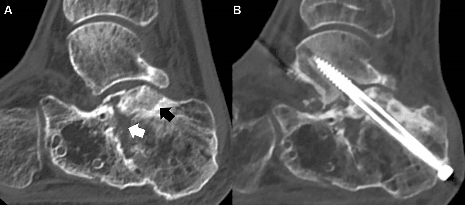 Two CT images of a post-traumatic calcaneus: arrows at the depressed posterior facet and the bone beneath it in A, and a single large screw from the calcaneus into the talus in B