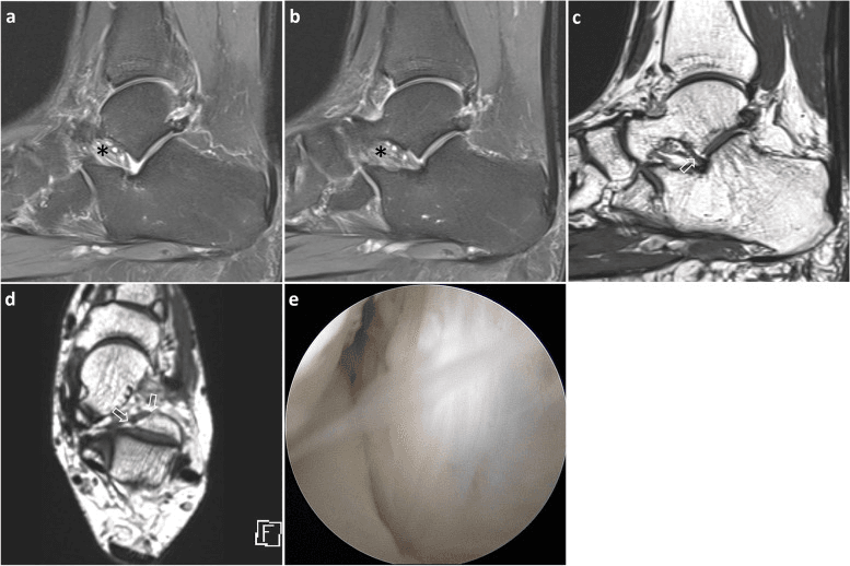MRI and arthroscopy showing sinus tarsi syndrome
