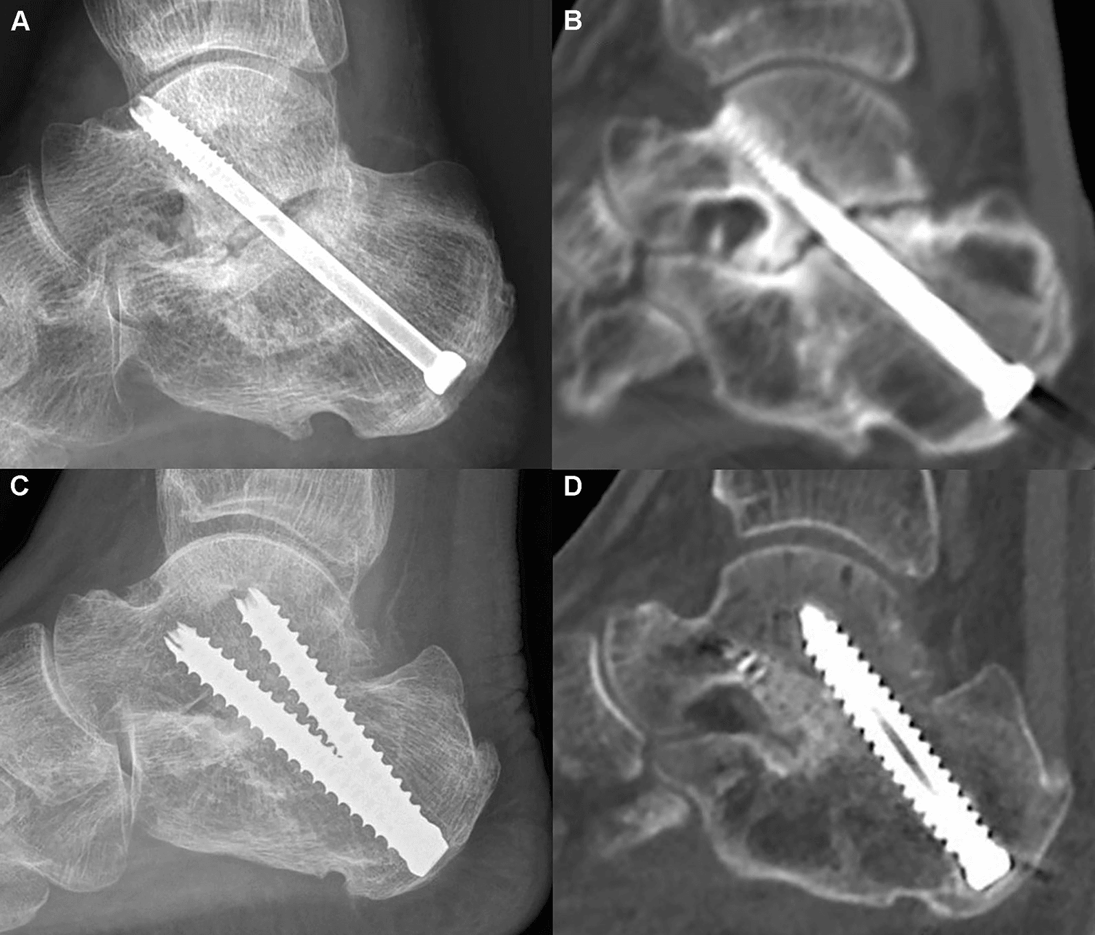 Radiograph and CT of a subtalar nonunion after a single partially threaded screw (A, B), and of union after two fully threaded screws (C, D)