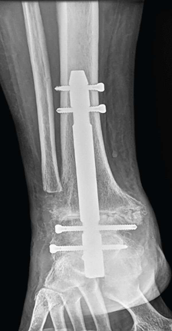 Radiograph of an ankle after failed tibiotalar fusion, with an intramedullary nail and locking screws in place