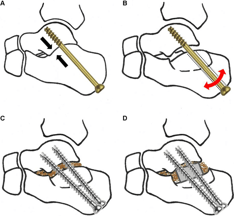 Four-panel schematic, A to D, of a partially threaded screw across contacting and gapped subtalar surfaces, and two fully threaded screws with graft material and a grey structural block