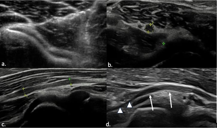 Ultrasound showing normal and enlarged posterior interosseous nerve at the arcade of Frohse