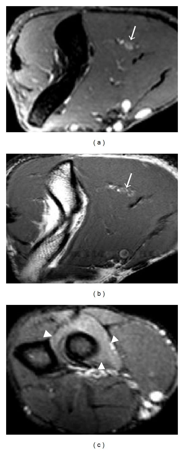 Axial MRI of posterior interosseous nerve entrapment with nerve swelling and supinator denervation oedema