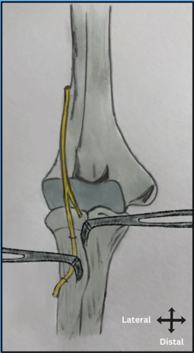 Schematic showing safe retractor placement around the proximal radius and posterior interosseous nerve