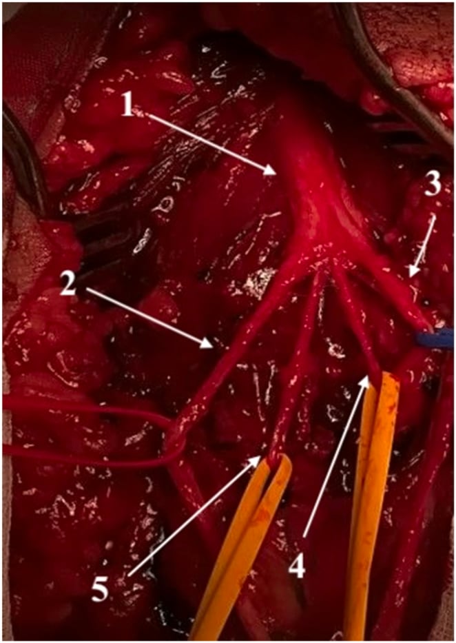 Operative dissection showing the radial nerve branching to the posterior interosseous nerve and supinator