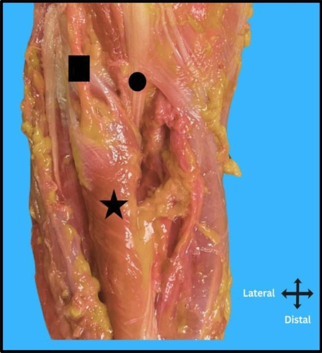 Cadaveric dissection showing the posterior interosseous nerve, distal biceps tendon and supinator
