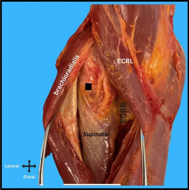 Cadaveric lateral elbow dissection showing the extensor carpi radialis longus, brachioradialis and supinator
