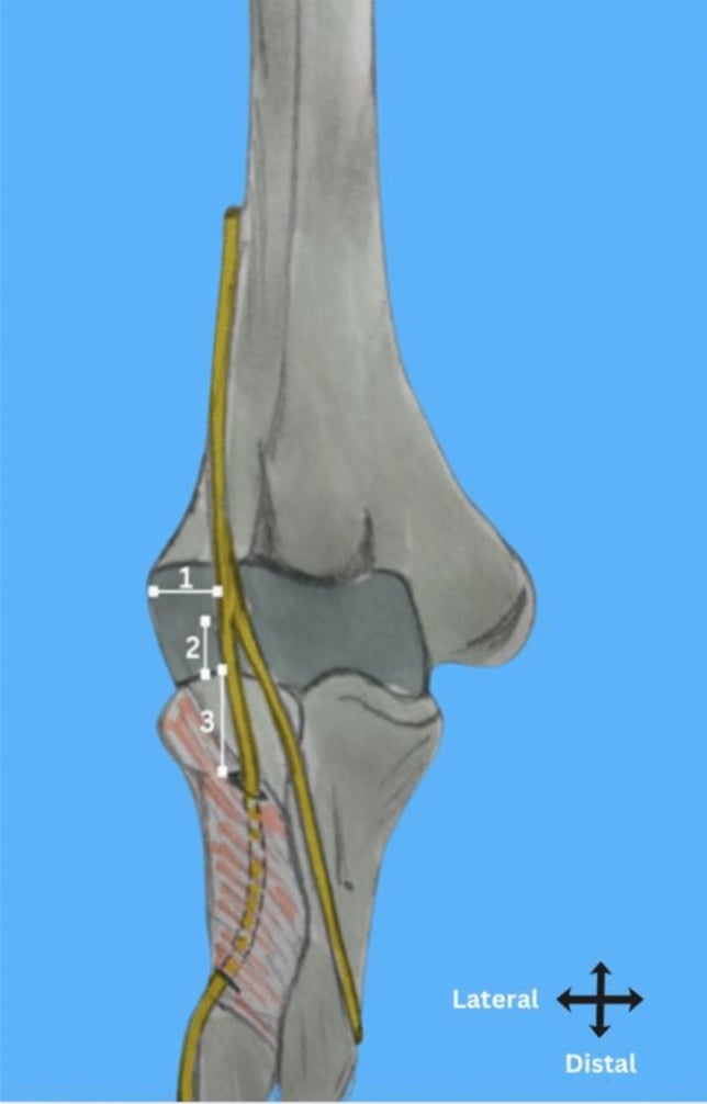 Schematic of posterior interosseous nerve landmarks around the proximal radius