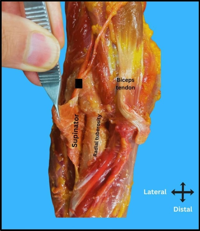 Cadaveric dissection showing the radiocapitellar joint and radial nerve bifurcation