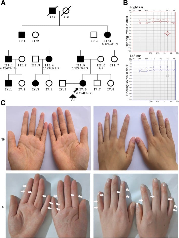 Pedigree, audiogram and clinical hand photographs in proximal symphalangism