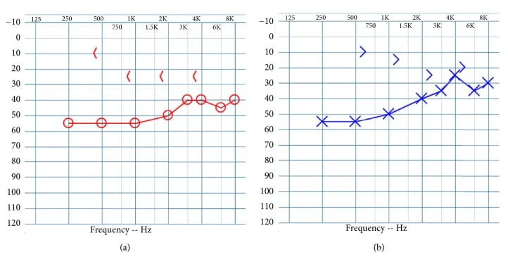 Bilateral pure-tone audiograms showing conductive hearing loss