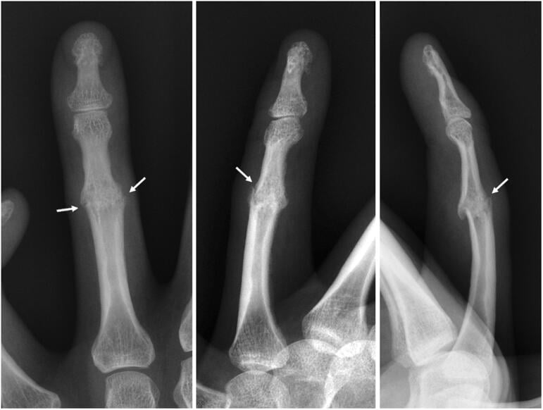 Radiographs showing a fracture through a fused ring-finger PIP joint