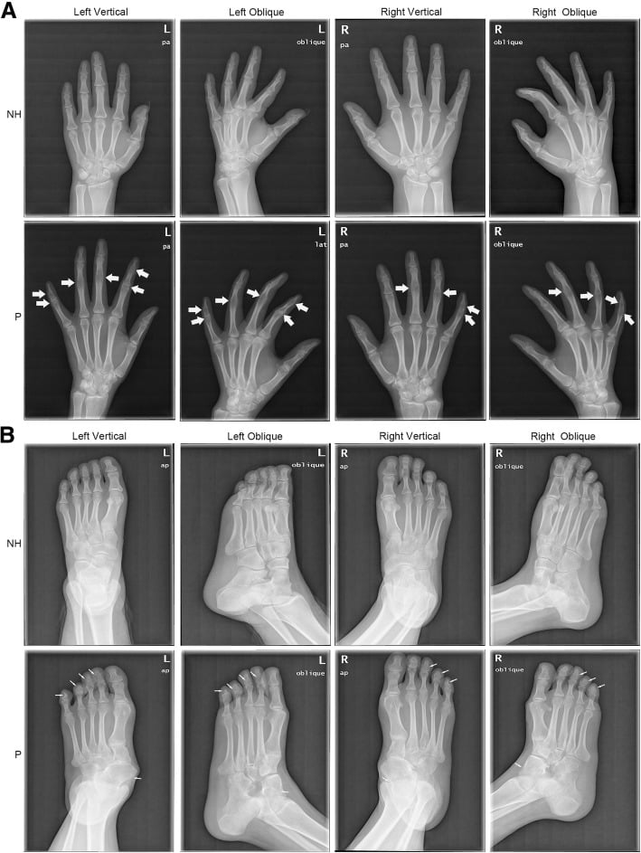 Comparative hand and foot radiographs showing digital symphalangism and talonavicular synostosis